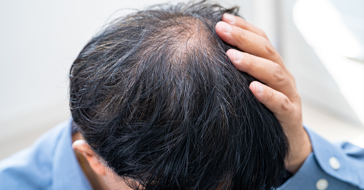 Man touching balding spot on top of head.