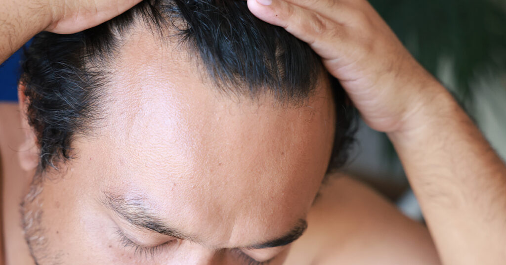 Early signs of receding hair line.