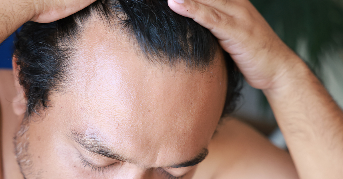 Early signs of receding hair line.