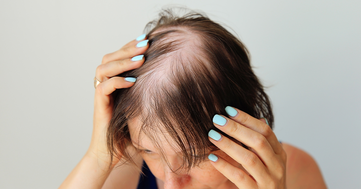 Thinning hair along the part