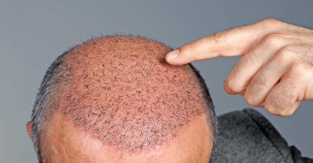 Post-treatment healing